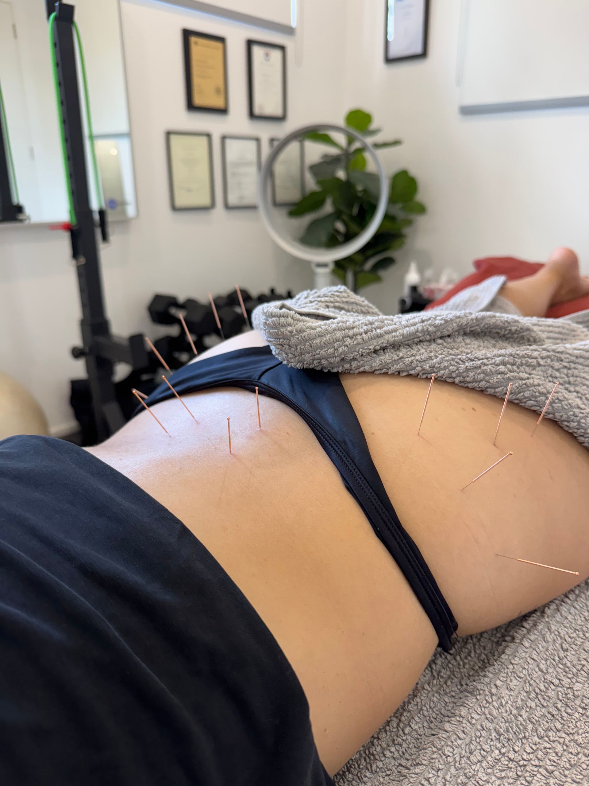 Trigger point dry needling at PACT Miranda